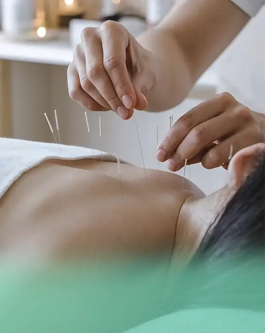 Acupuntura